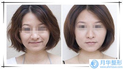 松原激光去除色素痣整形美容適合什么樣的女生