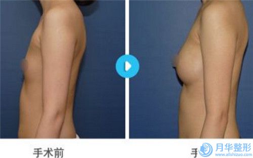 句容菲斯兔醫(yī)療美容診所做玻尿酸額頭注射填充哪個(gè)醫(yī)生好點(diǎn)