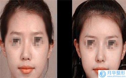 西安皮秒洗眉毛作用能夠維持很久