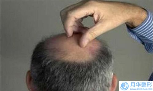 錫林郭勒埋蛋白線面部提升存在哪些風(fēng)險(xiǎn)