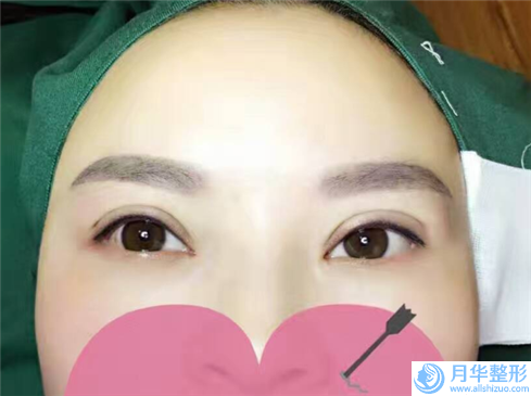 巴音郭楞開內(nèi)眼角修復(fù)價(jià)格的因素是什么