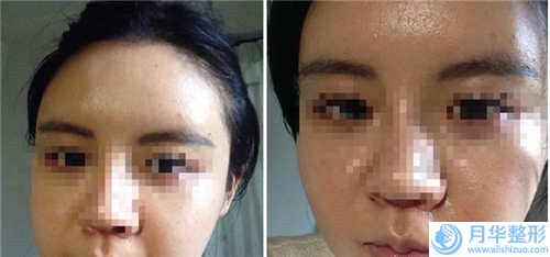 益陽伊維蘭注射墊下巴可不可以適用于未婚女性