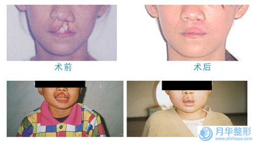咸陽(yáng)市下巴彎醫(yī)院的價(jià)格-咸陽(yáng)艾美萊醫(yī)學(xué)美容就不賴
