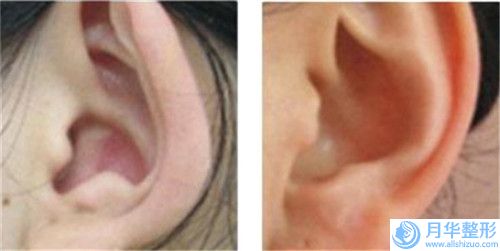 梧州縮小乳暈價(jià)格和費(fèi)用是怎么樣的
