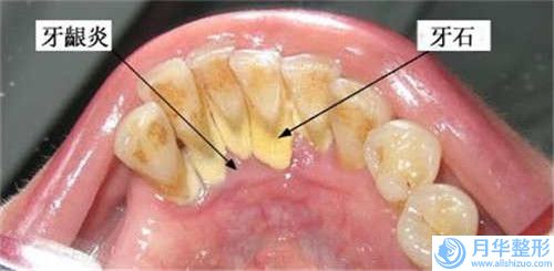 牡丹江腹部吸脂術(shù)手術(shù)價格的影響因素你知道多少呢