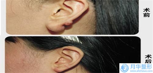 正規(guī)豐胸假體取出注射機(jī)構(gòu)推薦：豐胸假體取出注射醫(yī)院綜合實(shí)力前20佳哪個(gè)做得好