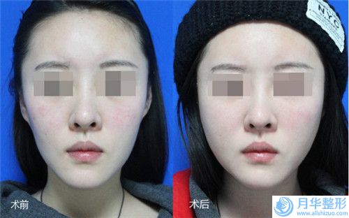 本溪唇裂和腭裂手術的費用高不高