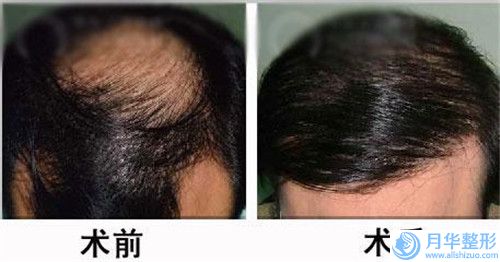 懷化蛋白線面部提升選擇哪種材料效果好
