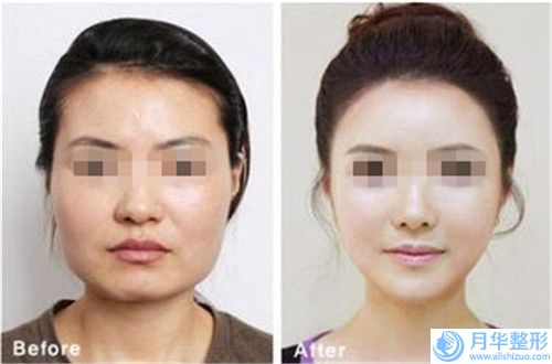 寶雞中心醫(yī)院整形美容科價格價位表官方一覽-人造酒窩手術(shù)案例