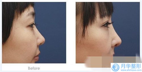 遼陽整形美容醫(yī)院整形價(jià)位表爆款正式發(fā)布-軟肋骨鼻子修復(fù)案例
