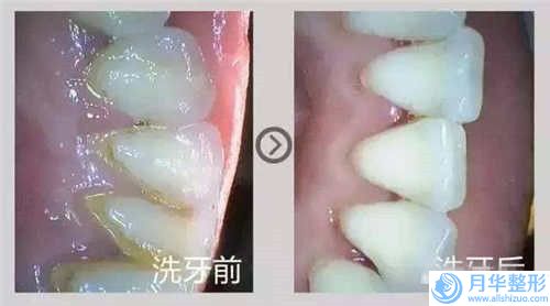 梅州圍龍屋口腔門診部自體脂肪注射移植可能會有什么副作用