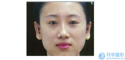 宜賓假體植入隆胸不適合人群主要有哪些