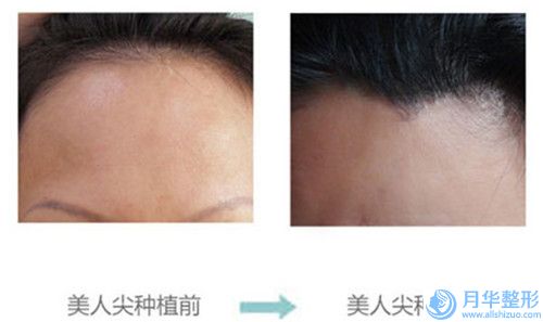 北京美麗嘉醫(yī)療美容打一針瘦臉針的危害性是什么