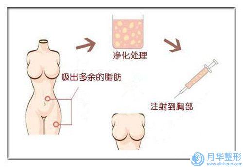 紹興自體脂肪填充豐額頭術(shù)后如何避免后遺癥的出現(xiàn)