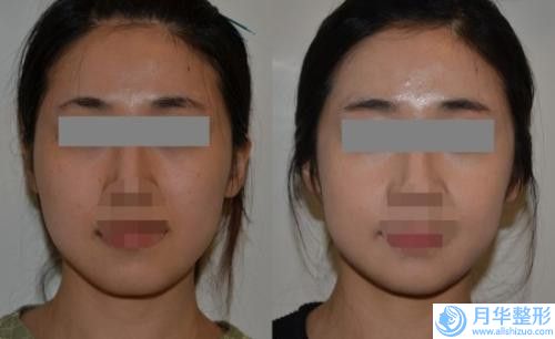 西寧小蘭醫(yī)療美容診所整形費(fèi)用表明細(xì)掛號容易嗎醫(yī)院實(shí)力附-微創(chuàng)切眉案例