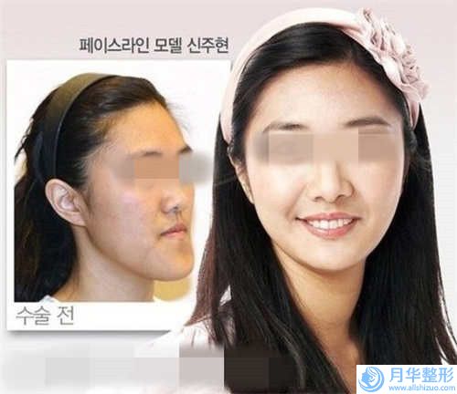 鹽城宸熙醫(yī)療美容門診部雙下巴溶脂手術(shù)真實費用