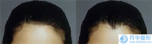 悅?cè)葆t(yī)療美容診所面頰矯正術(shù)后護(hù)理是怎樣的