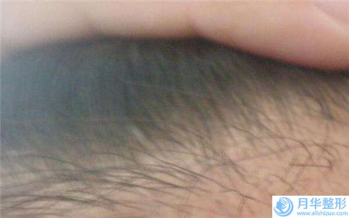 安琪兒私密醫(yī)美中心超薄全瓷貼面后需要怎么保養(yǎng)胸部