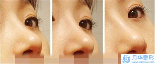雅安斯卡娣美醫(yī)療美容門診部?jī)r(jià)格表(費(fèi)用)具體-愛貝芙注射隆鼻術(shù)案例