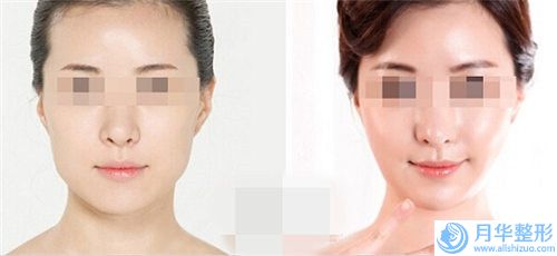 中國男生鼻翼縮小手術醫(yī)院推薦：男生鼻翼縮小手術醫(yī)院前50佳全面盤點