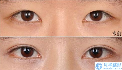 六盤水凹陷雙眼皮修復(fù)手術(shù)對(duì)健康會(huì)有影響嗎
