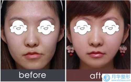 瀘州唇腭裂嘴唇修復(fù)對(duì)孩子有影響嗎