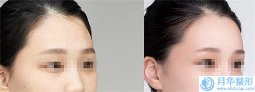 鷹潭成年人兔唇整容花費多不多