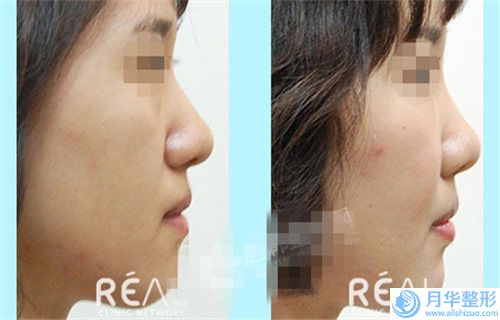 南昌佳美整形美容醫(yī)院做隆鼻整形價(jià)格是不是很高呢
