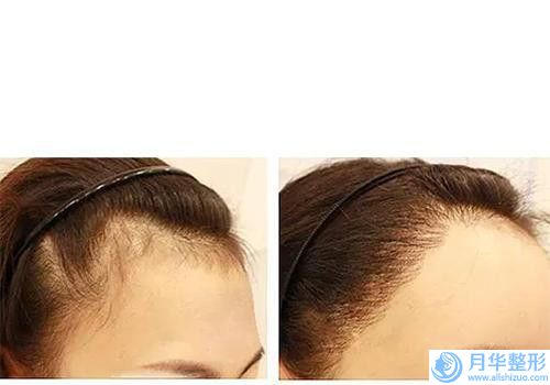 蕪湖丹鳳朝陽婦科醫(yī)院整形費用表明細全方面剖析-取出乳房假體手術(shù)修復(fù)案例