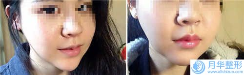 六安市填充下巴下巴醫(yī)院比較正規(guī)(六安市填充下巴下巴醫(yī)院上榜清單top10強(qiáng)榜單公布)