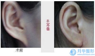 甘肅醫(yī)學(xué)院附屬醫(yī)院價(jià)格收費(fèi)表完整公開-乳頭縮小整形案例