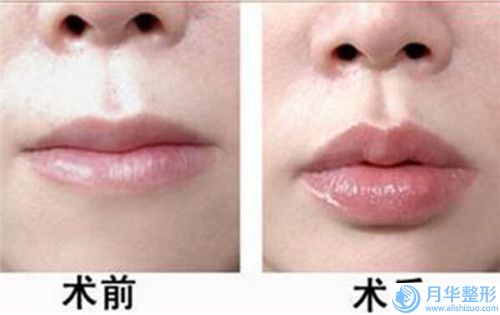 遵義市注射瘦雙下巴收費明細一期介紹(注射瘦雙下巴均價為：18167元）