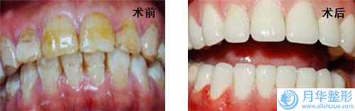 肌妍醫(yī)學(xué)美容中心注射溶脂瘦手臂術(shù)后護(hù)理及效果