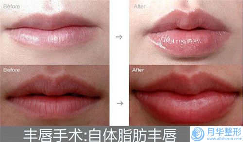 墊下巴假體的安全性以及并發(fā)癥