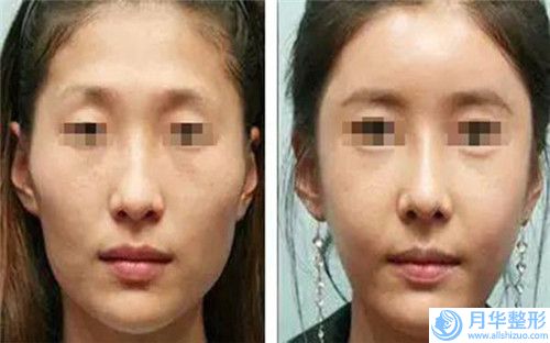 濟(jì)南美蓮美容整形整形費(fèi)用表明細(xì)現(xiàn)已公示-精細(xì)提眉案例