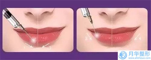 雞西市Dr.W王醫(yī)生整形外科門(mén)診部體脂肪填充下巴攻略
