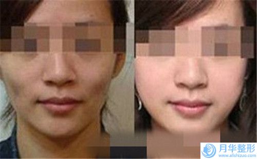重慶匯生初妍醫(yī)療美容診所價格(費用)清單修訂版公開-提眉手術案例
