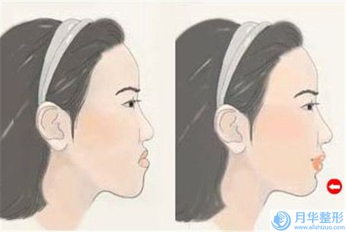 腰腹部抽脂減肥手術(shù)需要承擔(dān)風(fēng)險(xiǎn)嗎