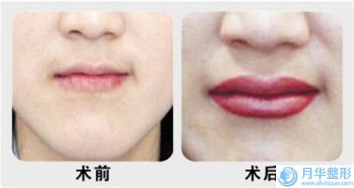 揭陽假體填充下巴費(fèi)用價(jià)格是多少