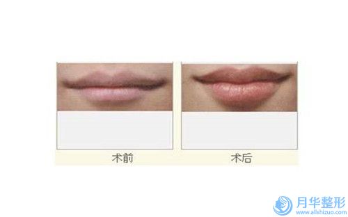 黔東南自體脂肪下巴整容的費用