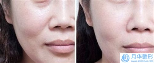 深圳恩吉娜醫(yī)療美容醫(yī)院隱形唇裂完全修復(fù)較低費(fèi)用