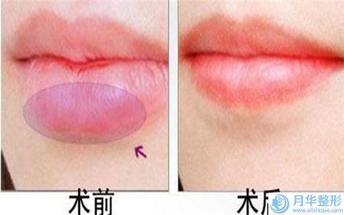 佛山市順德區(qū)龍江醫(yī)院手足外科整形外科價位表2024年一覽-注射整下巴案例