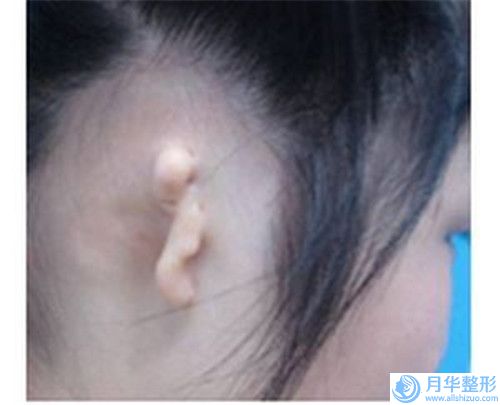 寧波自體脂肪豐胸術對生孩子有影響嗎