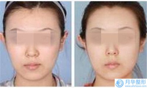 池州皮秒洗眉毛費(fèi)用高低不定的原因是什么