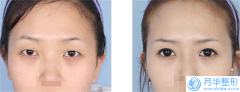 秦皇島女娃醫(yī)療美容整形機(jī)構(gòu)眼睛內(nèi)隱斜矯正要多少費(fèi)用呢