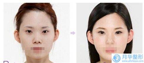 德州人民醫(yī)院整形外科費(fèi)用表明細(xì)勁爆新版2024一覽-埋式雙眼皮案例