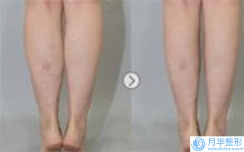 河南牙口腔門診部?jī)r(jià)格(價(jià)目)新鮮大出爐啦-骨性牙突矯正案例
