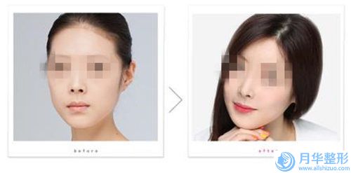 壽光麗宸醫(yī)療美容門診部價格表2024開箱種草-鼻梁骨歪手術(shù)矯正案例