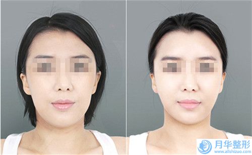 上海愉悅美聯(lián)臣醫(yī)療美容醫(yī)院下巴縮牙齒矯正醫(yī)院價格一覽表