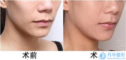 南通大學(xué)附屬醫(yī)院整形外科價(jià)格(費(fèi)用)清單清單-做唇裂修復(fù)案例